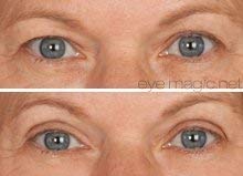 Eye Magic Original Eye Lift Kit (Small/Medium Size With Gel) Lifts Eyelid Droop and Hooded Eyes | Open And Show Off Your Beautiful Eyes | Made In America