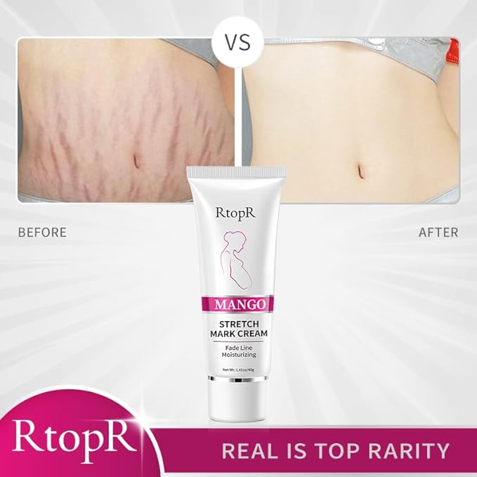 RtopR Mango Stretch Mark Cream for Pregnancy, Stretch Mark Repair Cream, Fade Line, Moisturizing and Non-Greasy, Safe to Use When Pregnant