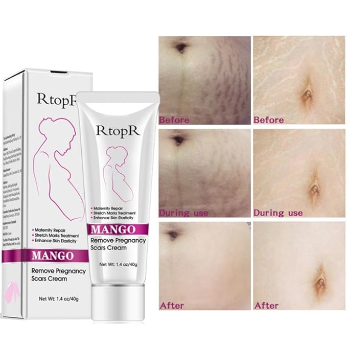 Mango Stretch Marks and Scar Cream, Stretch Marks and Scar Removal Cream for Pregnancy, Stretch Marks Scar Belly Creams for Wrinkles, Obesity Fat Stretch Mark Moisturizing, Remove Marks (40g)