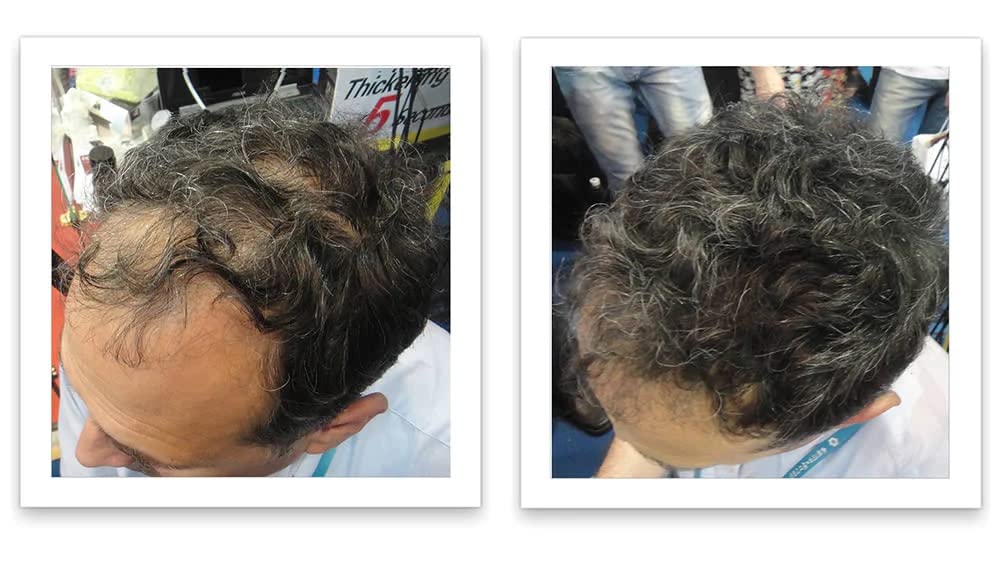 Caboki Hair Loss Concealer. All-Natural Hair Building Fiber. Make Thin Hair Look 10X Fuller Instantly. Eliminate the Appearance of Bald Spot and Thinning Hair (30G, 90-Day Supply). Salt & Pepper-Dark
