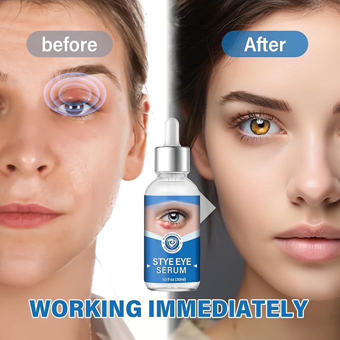 Stye Eye Treatment, Stye Eye Serum for Styes Chalazion and Blepharitis, Gently Cleanses Lashes and Eyes, Restore Healthier Eye Skin, 1 Fl.oz