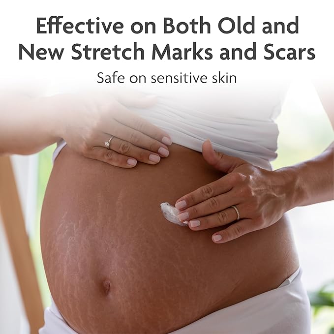TriLASTIN-SR Intensive Stretch Mark Cream (5.5 oz.) for Pregnancy, Scar Cream and Moisturizing Lotion, Cocoa Butter, Scar Treatment, Hypoallergenic and Paraben-Free