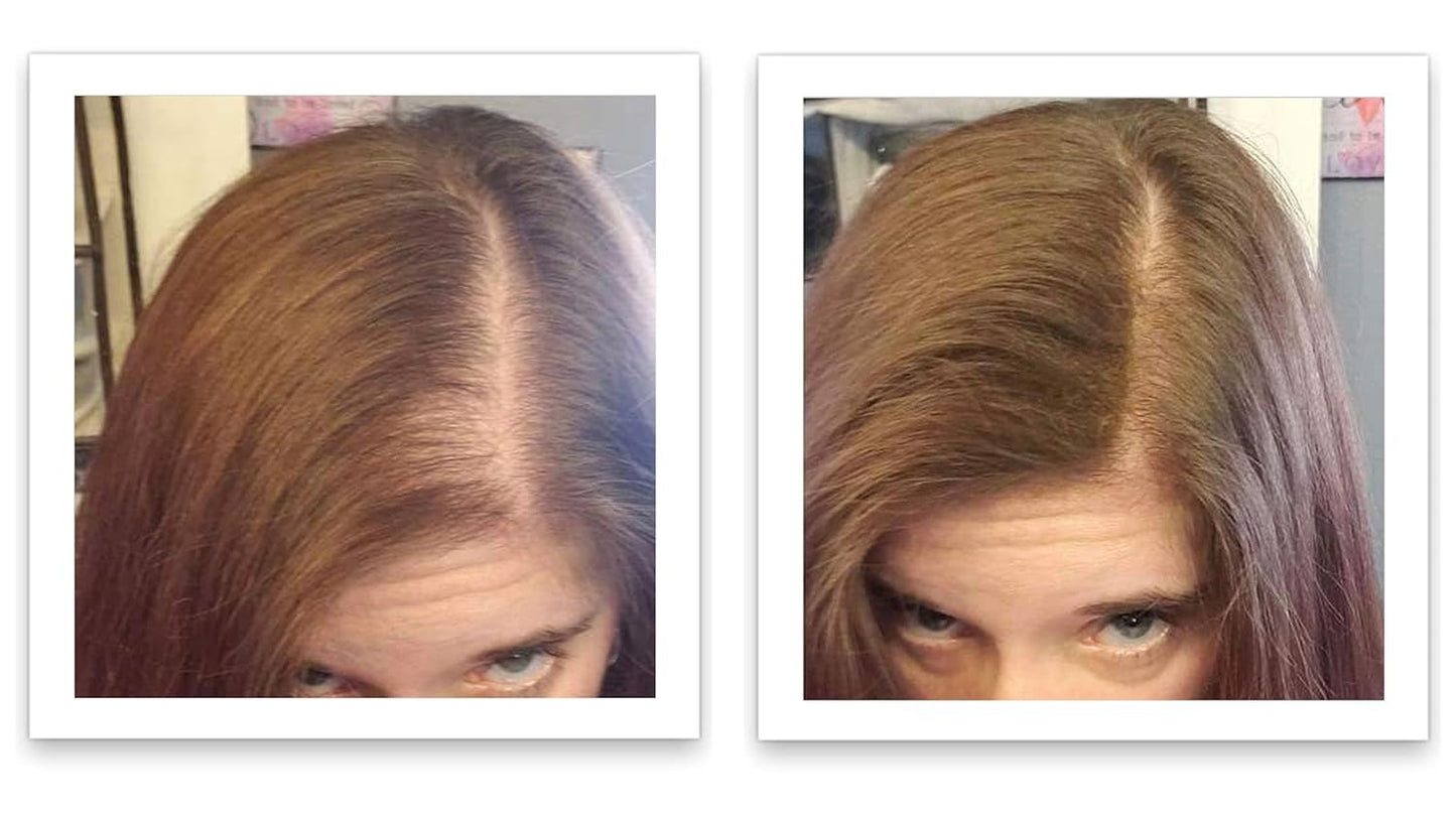 Caboki All-Natural Hair Building Fiber. Make Thin Hair Look 10X Fuller Instantly. Eliminate the Appearance of Bald Spot and Thinning Hair (30G, 90-Day Supply). Medium Brown