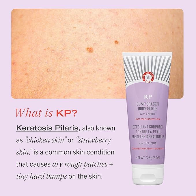 First Aid Beauty KP Bump Eraser Body Scrub Exfoliant for Keratosis Pilaris with 10% AHA 4 oz.