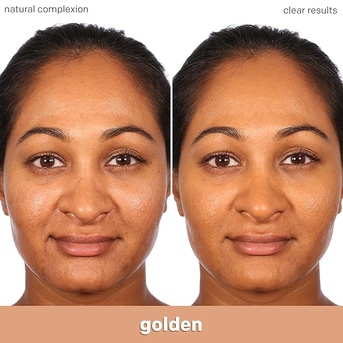 Almay Clear Complexion Acne Foundation Makeup with Salicylic Acid - Lightweight, Medium Coverage, Hypoallergenic, Fragrance-Free, for Sensitive Skin, 750 Golden, 1 fl oz.