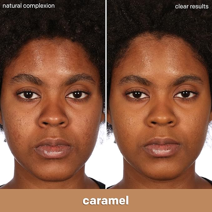 Almay Clear Complexion Acne Foundation Makeup with Salicylic Acid - Lightweight, Medium Coverage, Hypoallergenic, Fragrance-Free, for Sensitive Skin, 800 Caramel, 1 fl oz.