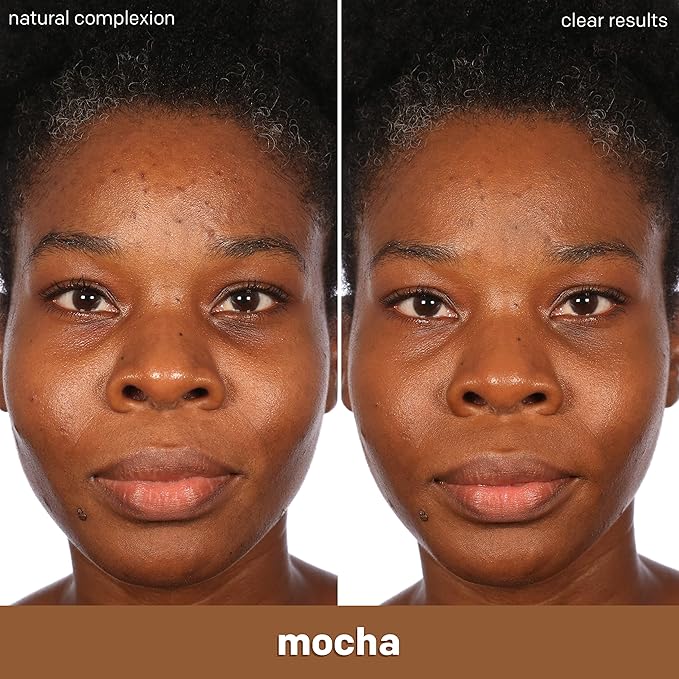 Almay Clear Complexion Acne Foundation Makeup with Salicylic Acid - Lightweight, Medium Coverage, Hypoallergenic, Fragrance-Free, for Sensitive Skin, 910 Mocha, 1 fl oz.